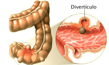 diverticulo